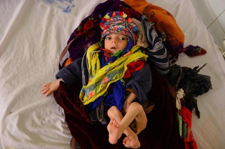 Photo: Omid, ten months malnourished child suffering from pneumonia is treated in Mofleh Pediatric Hospital in the province of Herat province, west of Afghanistan on January 29, 2019. © UNICEF/UN0280720/Hashimi AFP-Services